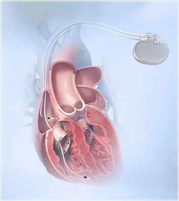 pacemaker pacemaker